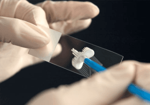 India launches affordable device for cervical cancer tests