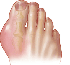 CSIR-NBRI Creates Herbal Treatment to Improve Elderly Gout Symptoms