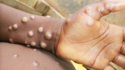 No Mpox Case Reported in India, PM Consistently Monitoring Situation: Centre