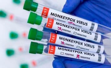 Government Confirms Mpox Virus Presence in Isolated Patient, Assures of No Widespread Risk