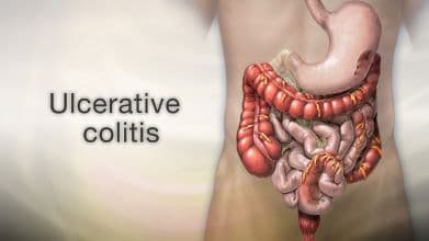 Scientists Link Specific Gene in Ulcerative Colitis to Colon Cancer Risk