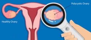 US Researchers Decode Origins of Ovarian Cancer