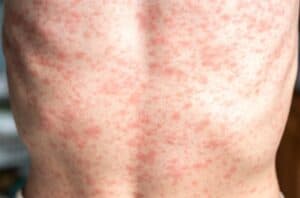 Third Measles Death Reported in US; Kennedy Visits West Texas Amid Rising Cases