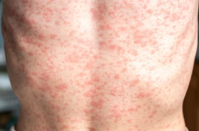 Third Measles Death Reported in US; Kennedy Visits West Texas Amid Rising Cases