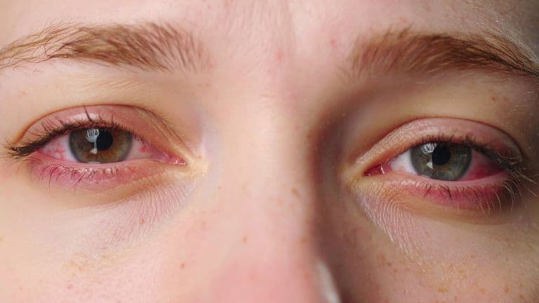 Just 1 Hour of Social Media Reels On Smartphones Can Cause Eye Fatigue: Study