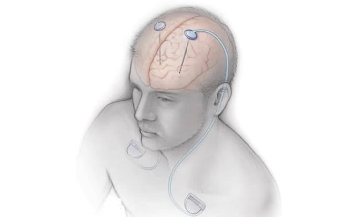 AIIMS Hosts India’s First Advanced Deep Brain Stimulation Workshop for Parkinson’s and Movement Disorders