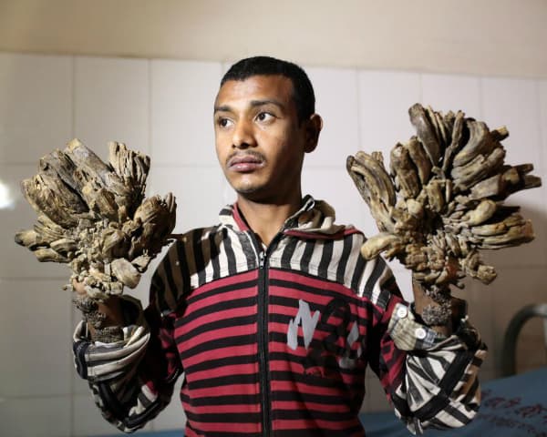 Bangladesh 'Tree Man' hopes to return to work after operation