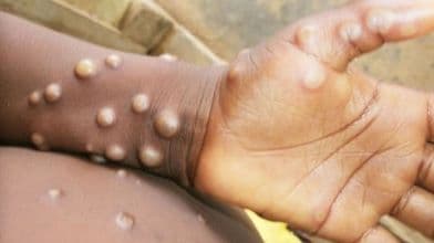 Sweden Reports First Instance of a More Contagious Form of Mpox Virus Outside Africa
