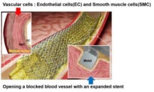 New Laser Patterning Technology to Revolutionise Stent Surgery for Heart Diseases