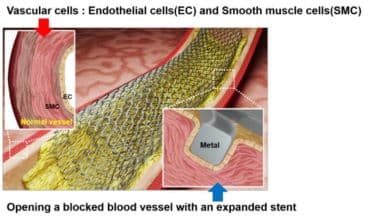 New Laser Patterning Technology to Revolutionise Stent Surgery for Heart Diseases