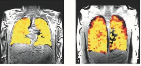 Scientists Develop Scanning Technique That Unravels Secrets of Lung Function; Good News for Lung Transplant, Asthma, COPD Patients