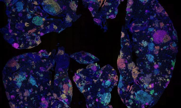 Study Finds Blood Marker That Could Detect Lung Cancer Risk Years in Advance