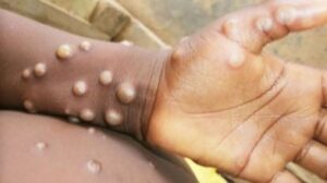 Sweden Reports First Instance of a More Contagious Form of Mpox Virus Outside Africa