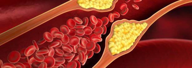 High Cholesterol, Microplastics Contribute to Heart Diseases