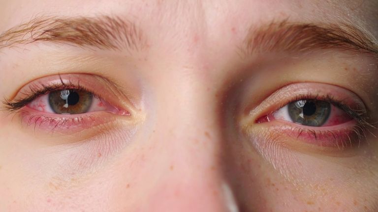 Just 1 Hour of Social Media Reels On Smartphones Can Cause Eye Fatigue: Study
