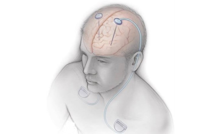AIIMS Hosts India’s First Advanced Deep Brain Stimulation Workshop for Parkinson’s and Movement Disorders