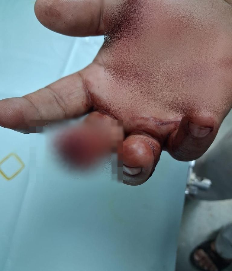 Mumbai Horror: Customer Bites Off Shopkeeper’s Finger in Malad Over Minor Dispute